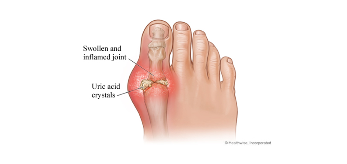 Gout and Pseudogout BCM